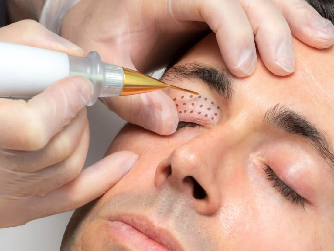 Lidstraffung: Behandlung mit dem Plasma Pen
